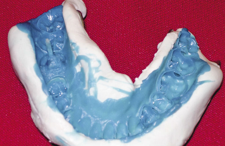 Рис. 5б. Этапы восстановления зуба с помощью композитной вкладки.