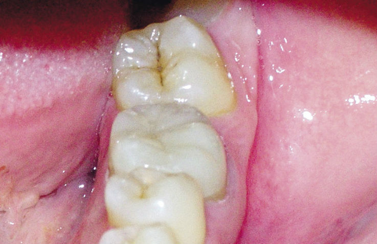 Рис. 5е. Этапы восстановления зуба с помощью композитной вкладки.