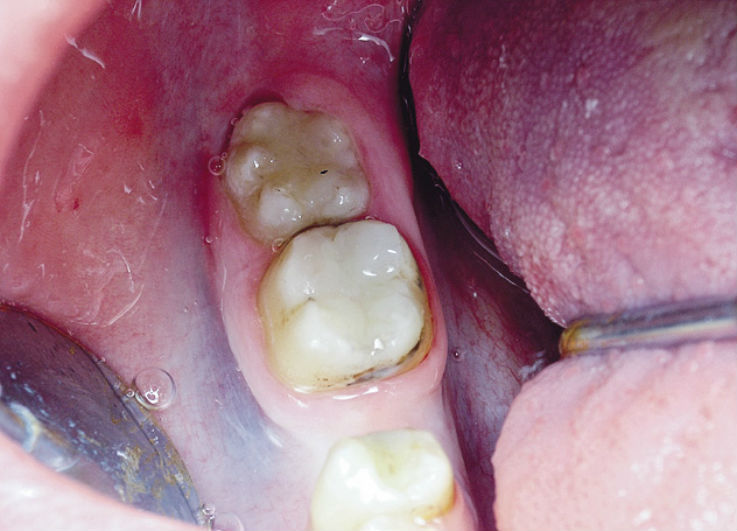 Рис. 6. Зуб 4.7: окончательный вид зуба после реставрации.