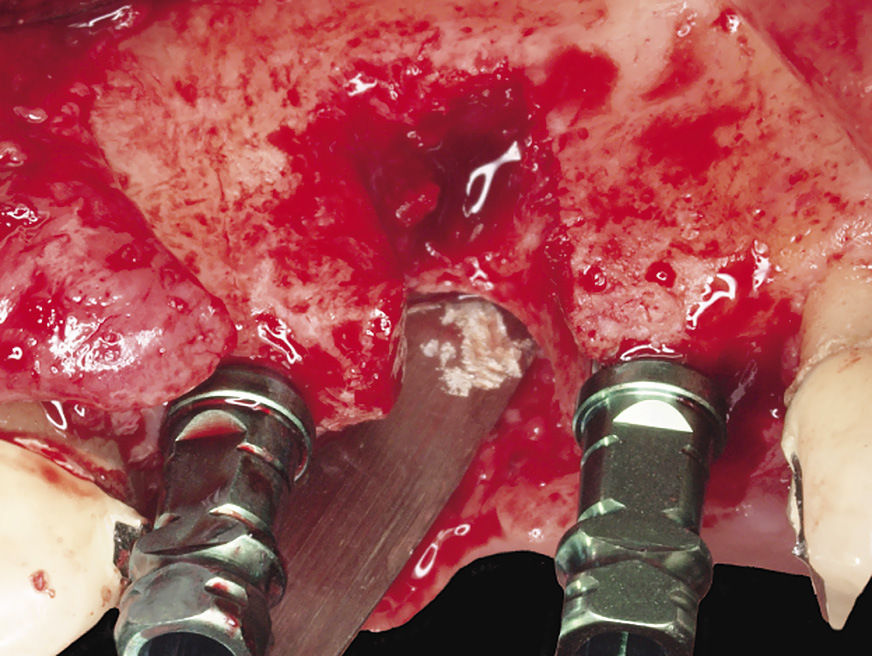 Рис. 6. Имплантаты установлены в позициях 23 и 25 зубов, около костного дефекта.