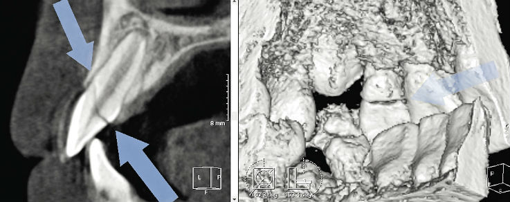 Рис. 2. КТ, визуализация зуба 22, сагиттальный реформат и объемный рендеринг; полный коронко-коронковый перелом в пределах эмали, дентина, пульпы и цемента.