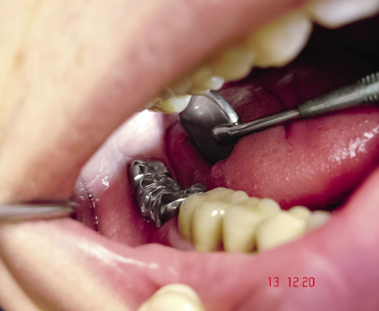 Рис. 7. Клиническая ситуация в полости рта больного С. после фиксации ортопедической конструкции.