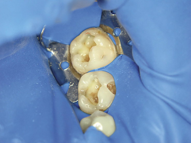Рис. 1. Исходная клиническая ситуация: зубы 36 и 37 — имеются кариозные полости.
