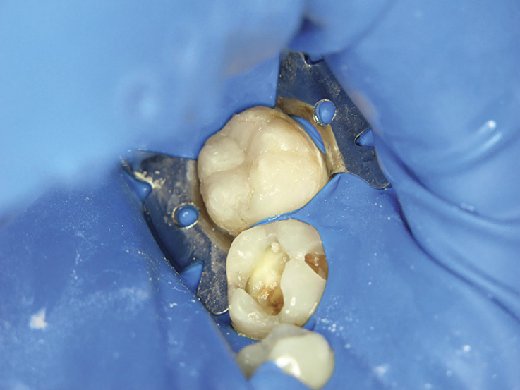 Рис. 3. Восстановление окклюзионной поверхности зуба 37 с помощью композита «X-tra fil».