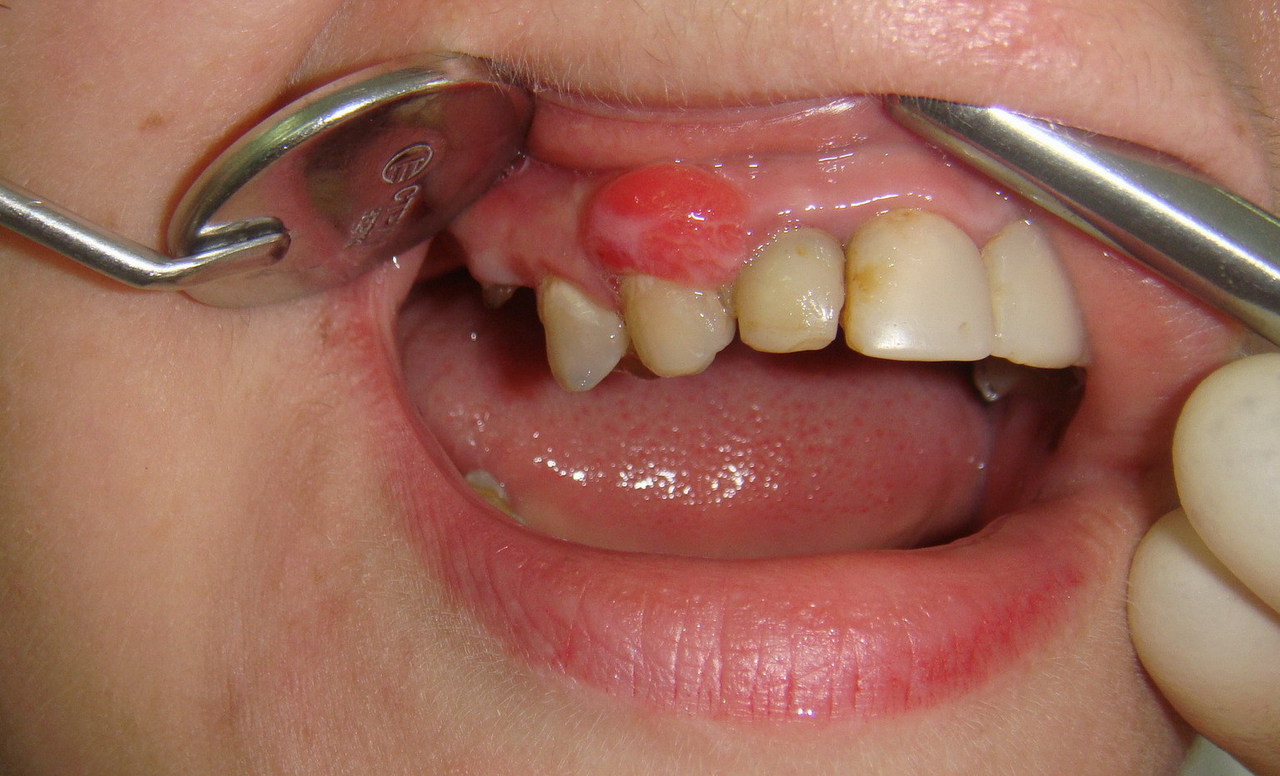 Пломбирование каналов зуба при аллергии thumbnail