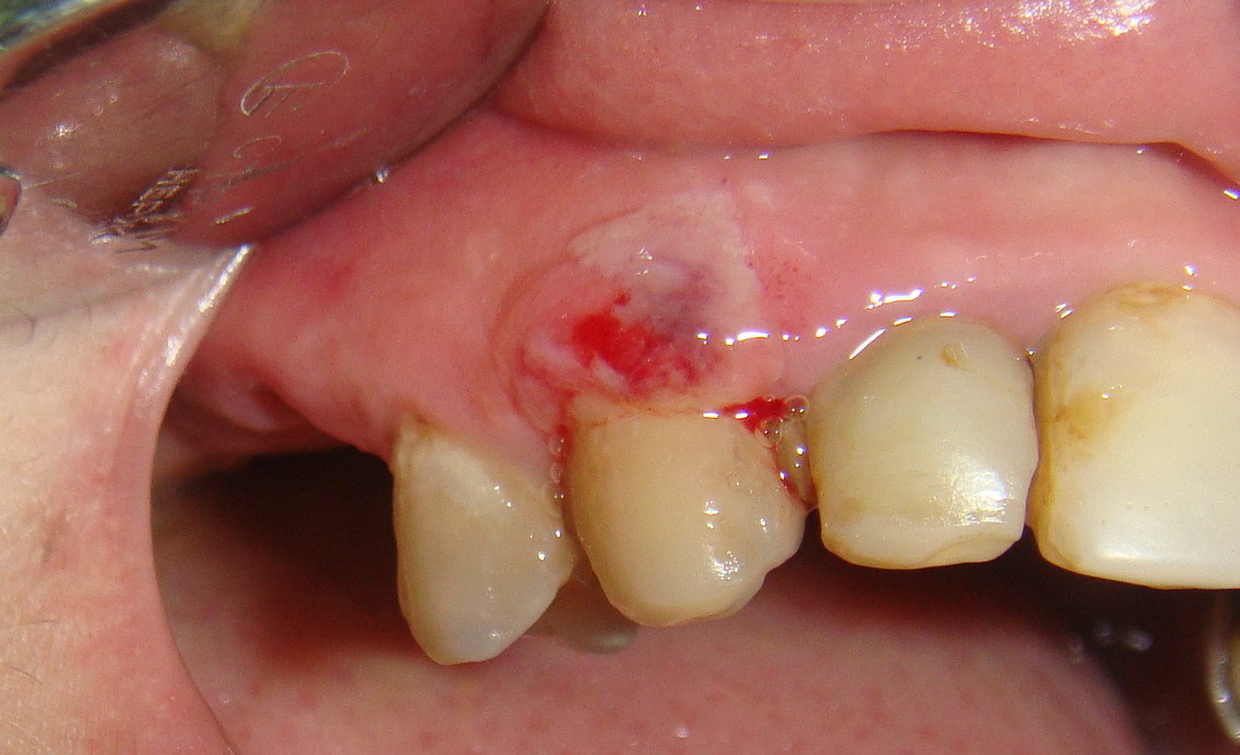 Аллергия на материал в стоматологии thumbnail