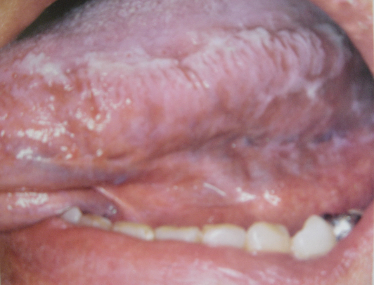 Рис. 7. Волосистая лейкоплакия вентральной и дорсальной поверхности языка.