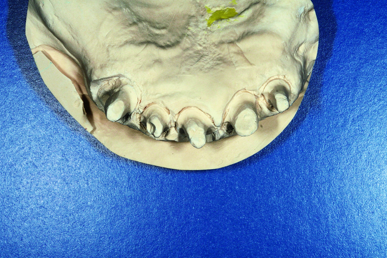 Рис. 1. Проверка параллельности отпрепарированных зубов.