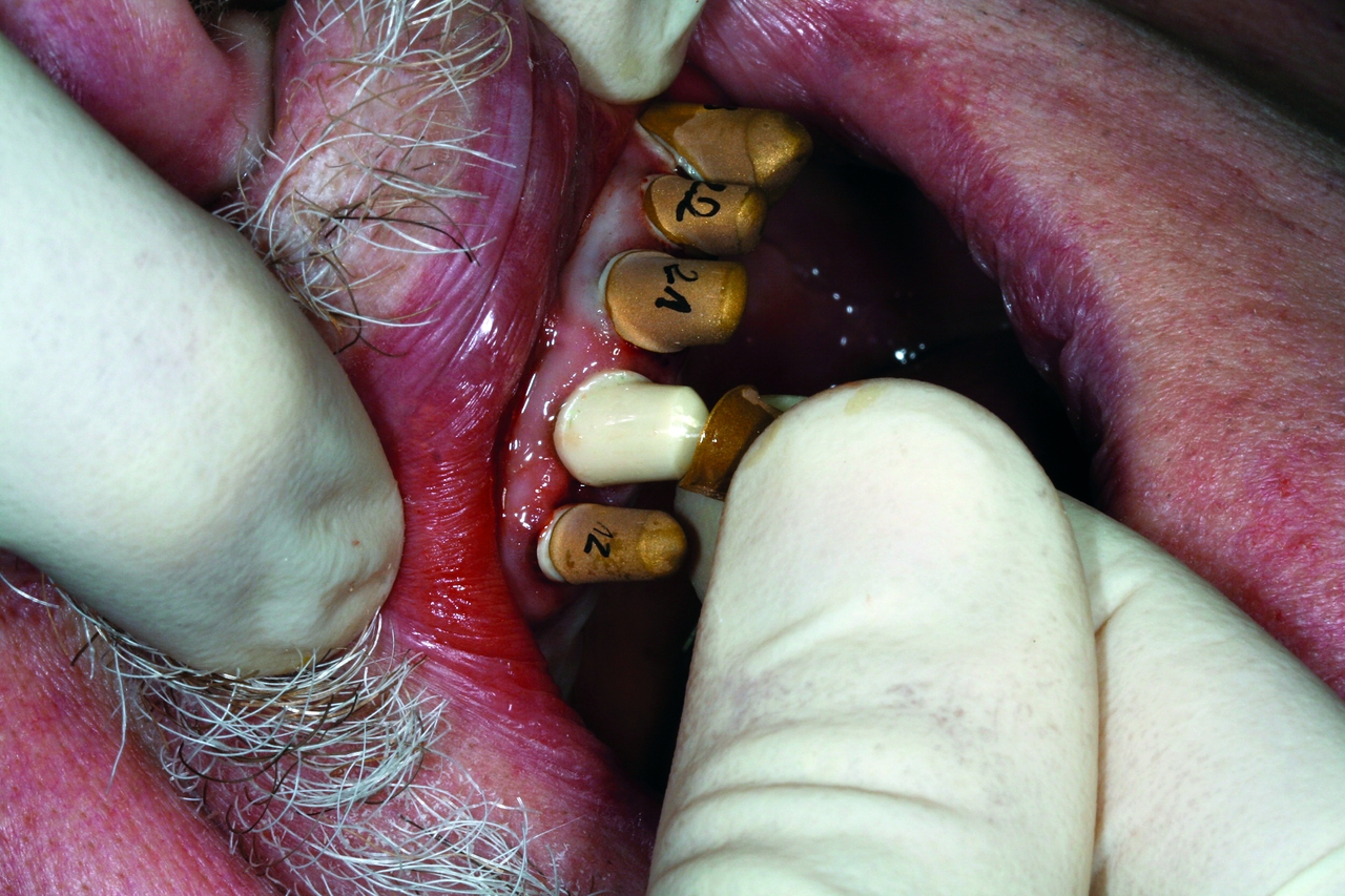 Рис. 10. Установка первичных и вторичных колпачков во рту пациента.