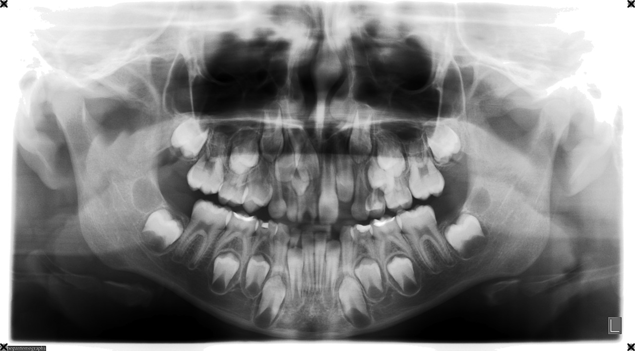 Рис. 1. ОПТГ, мальчик 8 лет, сверхкомплектные зубы в переднем отделе верхней челюсти. 