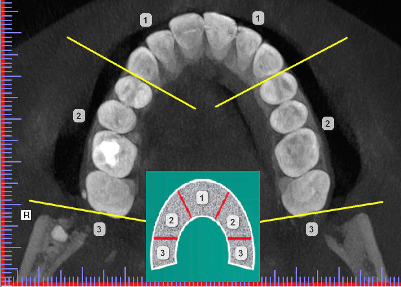 Рис. 5. Схема классификации СКЗ по топографии нахождения в зубной дуге согласно МКБ-10. 1 — область положения мезиоденса, 2 — параденса, 3 — дистоденса. 
