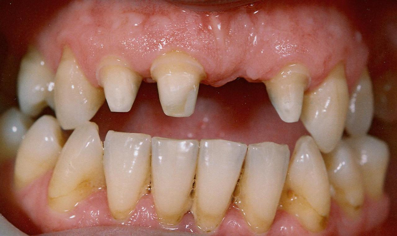 Рис. 10. Пациент И. после этапа препарирования зубов: десна без признаков травмы.