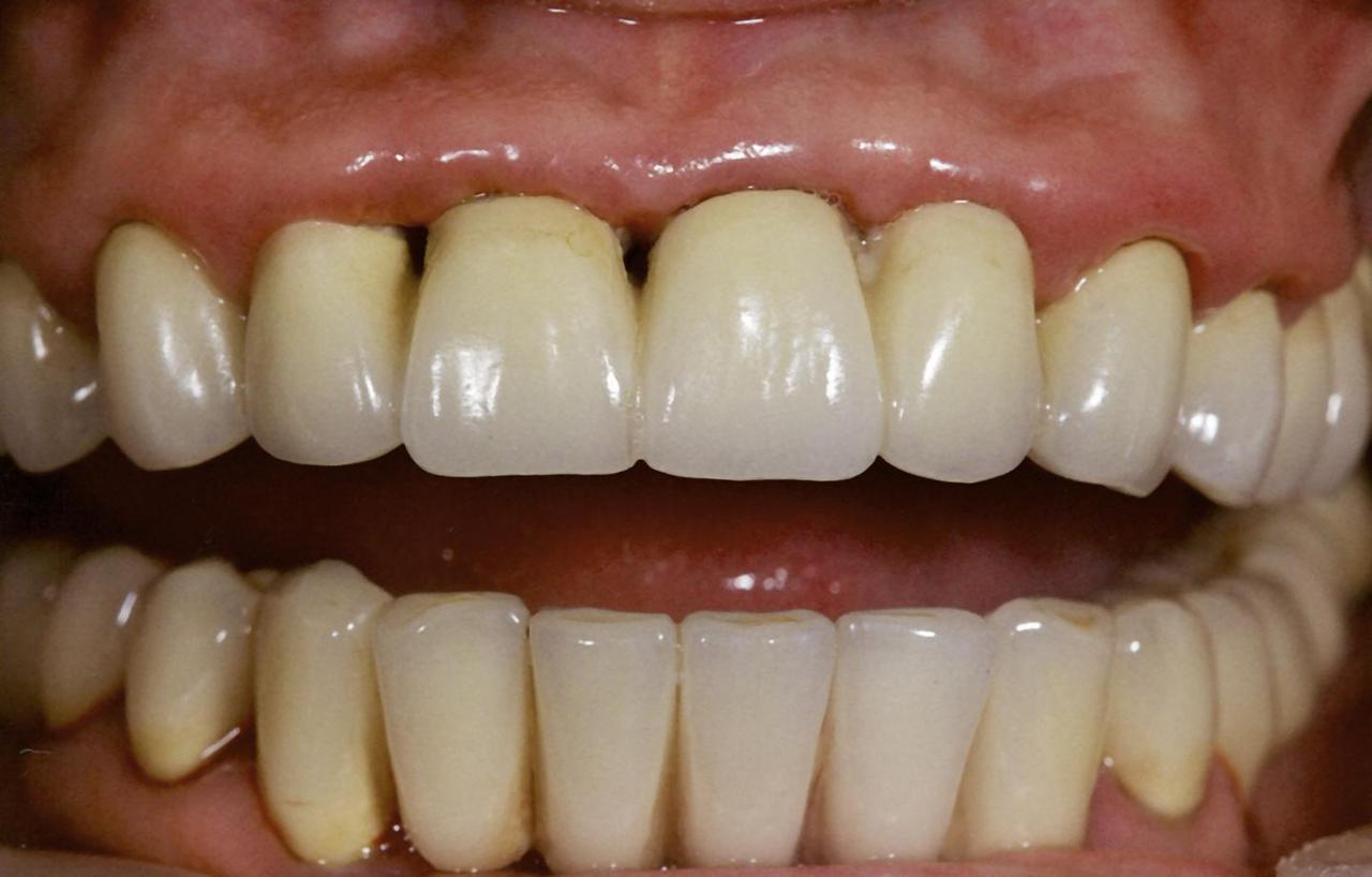 Рис. 3. Пациентка В., 2001 г. На этапе протезирования нижнего зубного ряда.