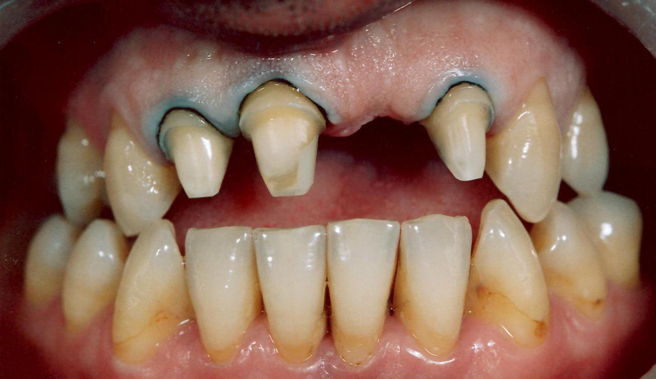 Рис. 9. Пациент И. после препарирования зубов. Придесневые уступы сформированы ниже уровня десневого края.