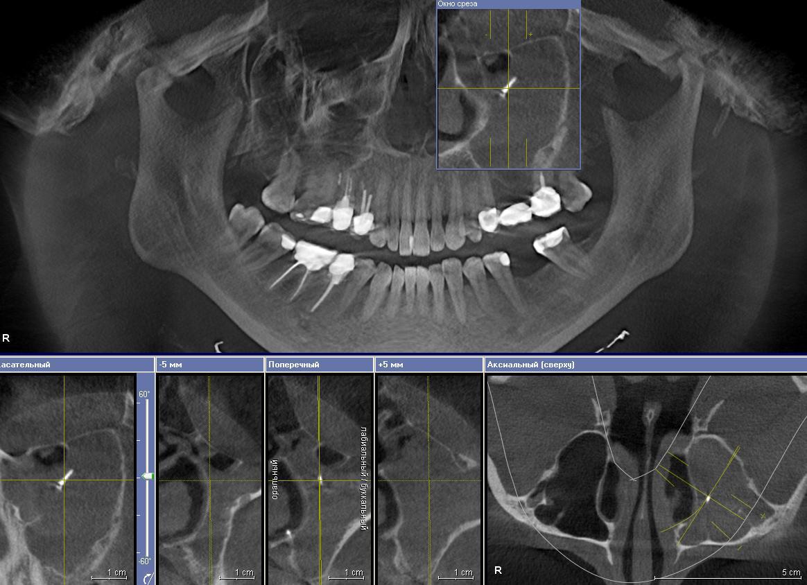 Рис. 4. 3ДКТ. Состояние после ортопедического лечения. Инородное тело (штифт) в левой гайморовой пазухе. Субтотальный одонтогенный гайморит слева.