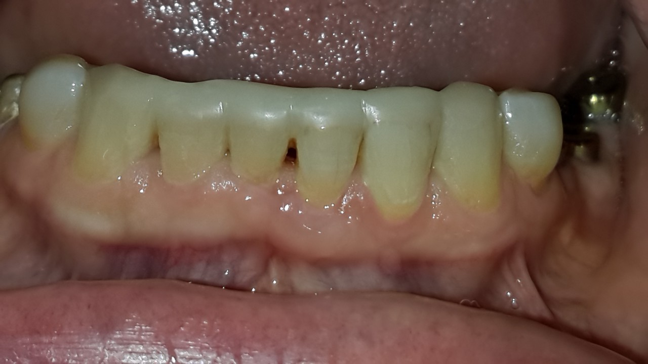 Рис. 5. Проведено восстановление нижних передних зубов шинирующей композитной реставрацией.