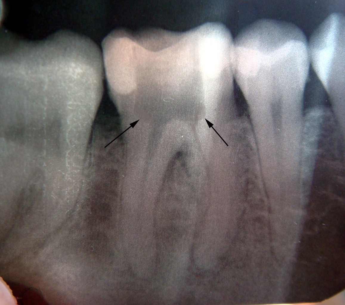 2 корня в зубе. Перфорация шейки зуба рентген. Коронковые перфорации зуба. Перфорация стенки корневого канала. Апикальный периодонтит.