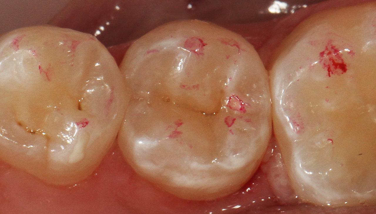Рис. 14. Вид реставрации зуба 35 после окончательного полирования, окклюзионная коррекция не проводилась.