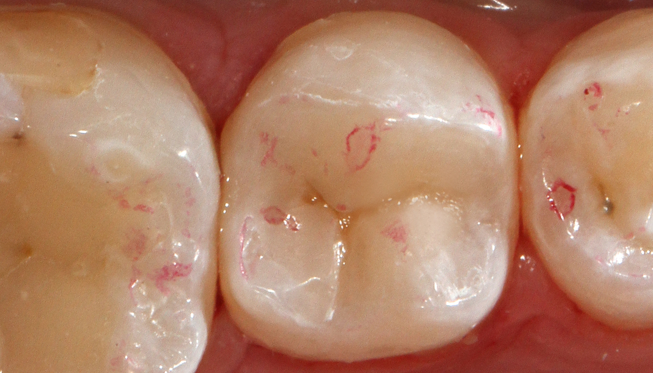 Рис. 20. Произведена незначительная окклюзионная коррекция реставрации зуба 45, полирование выполнено спиральными дисками Sof-Lex.