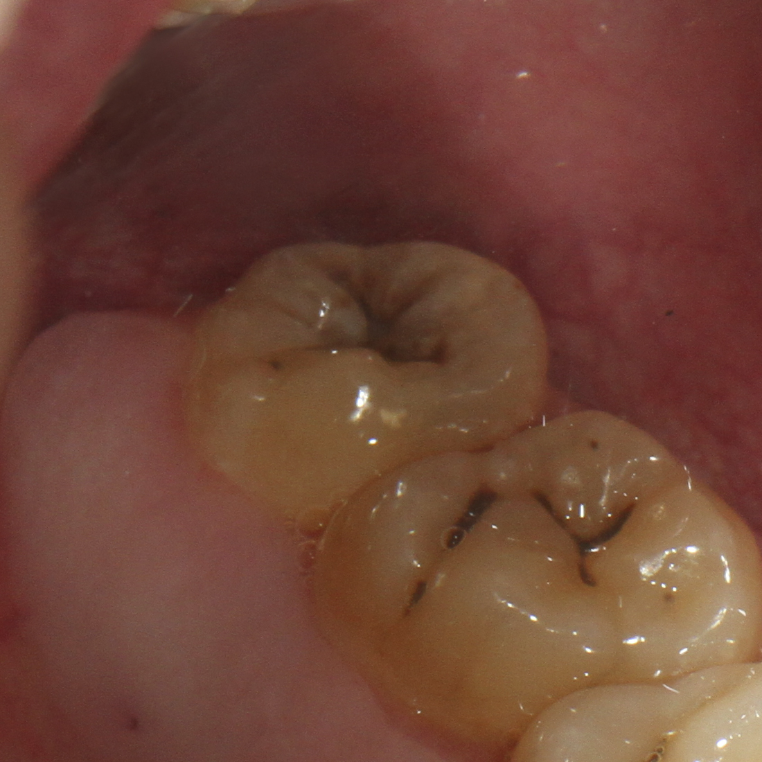Рис. 3. Исходная анатомия зуба 28. Диагноз: кариес дентина. Цвет А3 по шкале VITAPAN® Classical.
