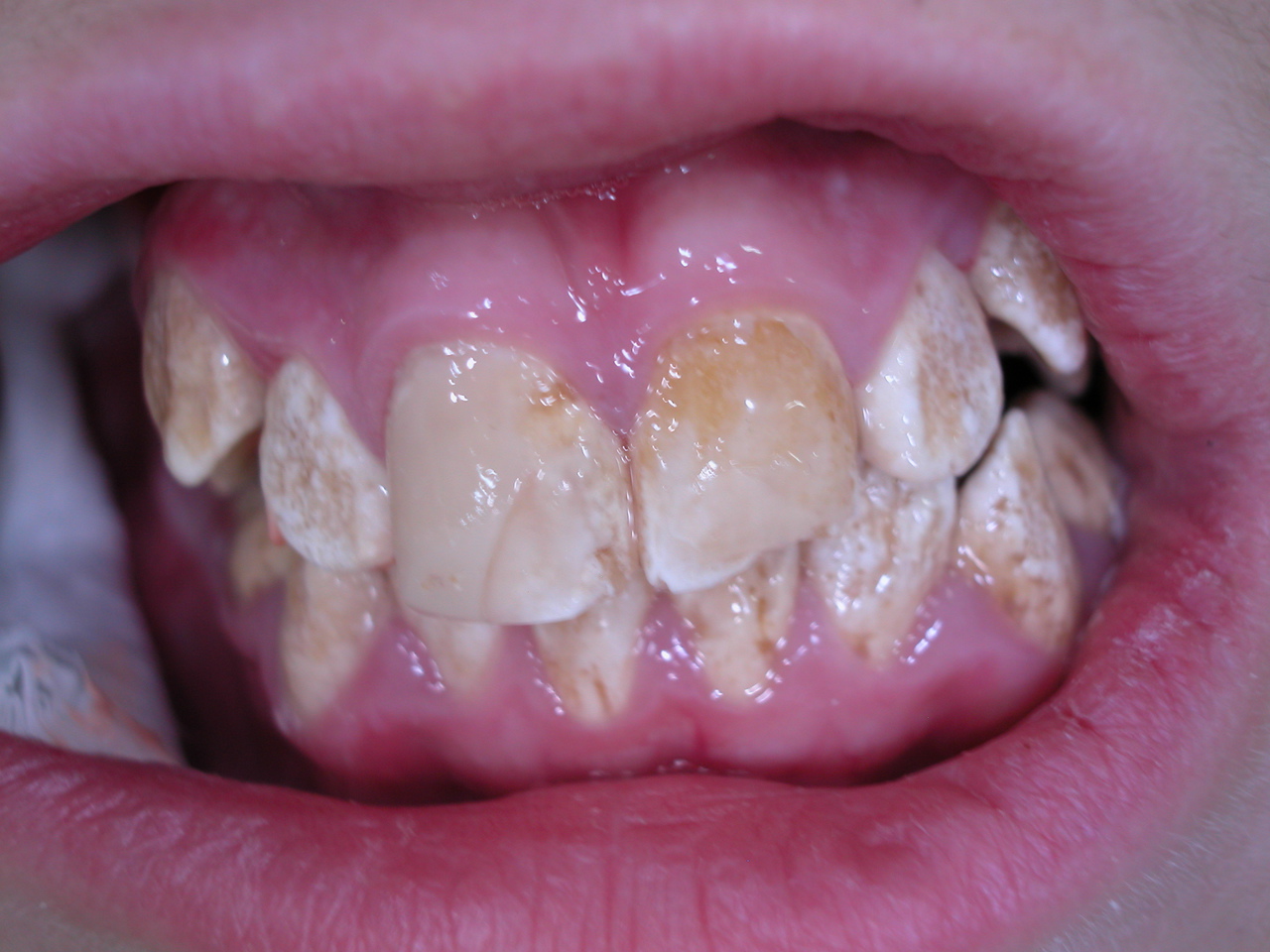 Рис. 1. Снимок полости рта пациента, страдающего amelogenesis imperfecta и демонстрирующего высокую кариозную активность.