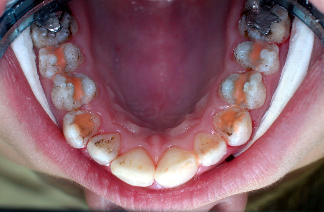 Рис. 2. Снимок полости рта пациента, демонстрирующий профилактическое нанесение стеклоиономерного цемента для запечатывания фиссур на все подвергающиеся риску поражения поверхности зубов у пациента с amelogenesis imperfecta.
