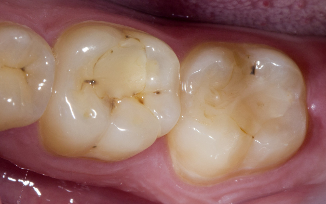Рис. 1. Исходная клиническая ситуация: зубы 4.6, 4.7 — неудовлетворительные реставрации.