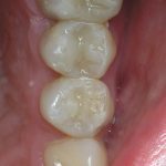 Зубы 2.4 и 2.5: окончательный вид реставраций (рис. 11)