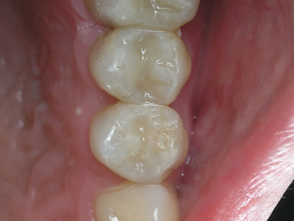 Зубы 2.4 и 2.5: окончательный вид реставраций (рис. 11)