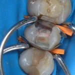 Зуб 2.5: после эндодонтического лечения зуб подготовлен для проведения реставрации. Установлена матричная система (рис. 5)