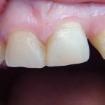 Включенный дефект зубной дуги: отсутствуют 12 и 22 зубы (рис. 1)