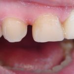 Отсутствует латеральный резец с правой стороны, клык смещен мезиально, тремы между 14 и 13 зубами, а также между 13 и 12 зубами (рис. 14)