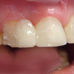 Композиционный материал для 12 зуба частично размещен на клыке (рис. 17)