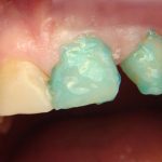 Травление твердых тканей опорных зубов (рис. 6)