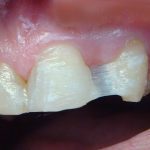 На опорных зубах адаптирована адгезивная лента «ГрандТЕК» (рис. 7)