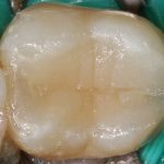 Воспроизведение анатомии зуба путем «карвинга».