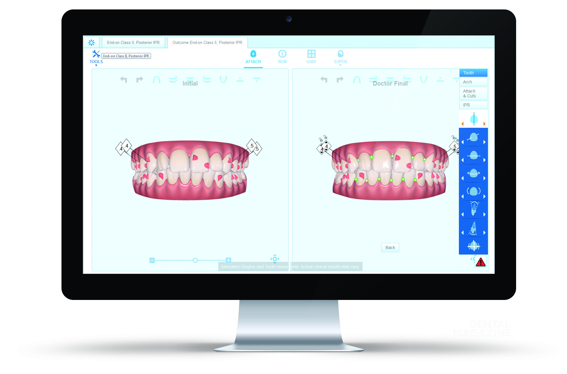 Система прозрачных элайнеров Invisalign Go производства Align ...