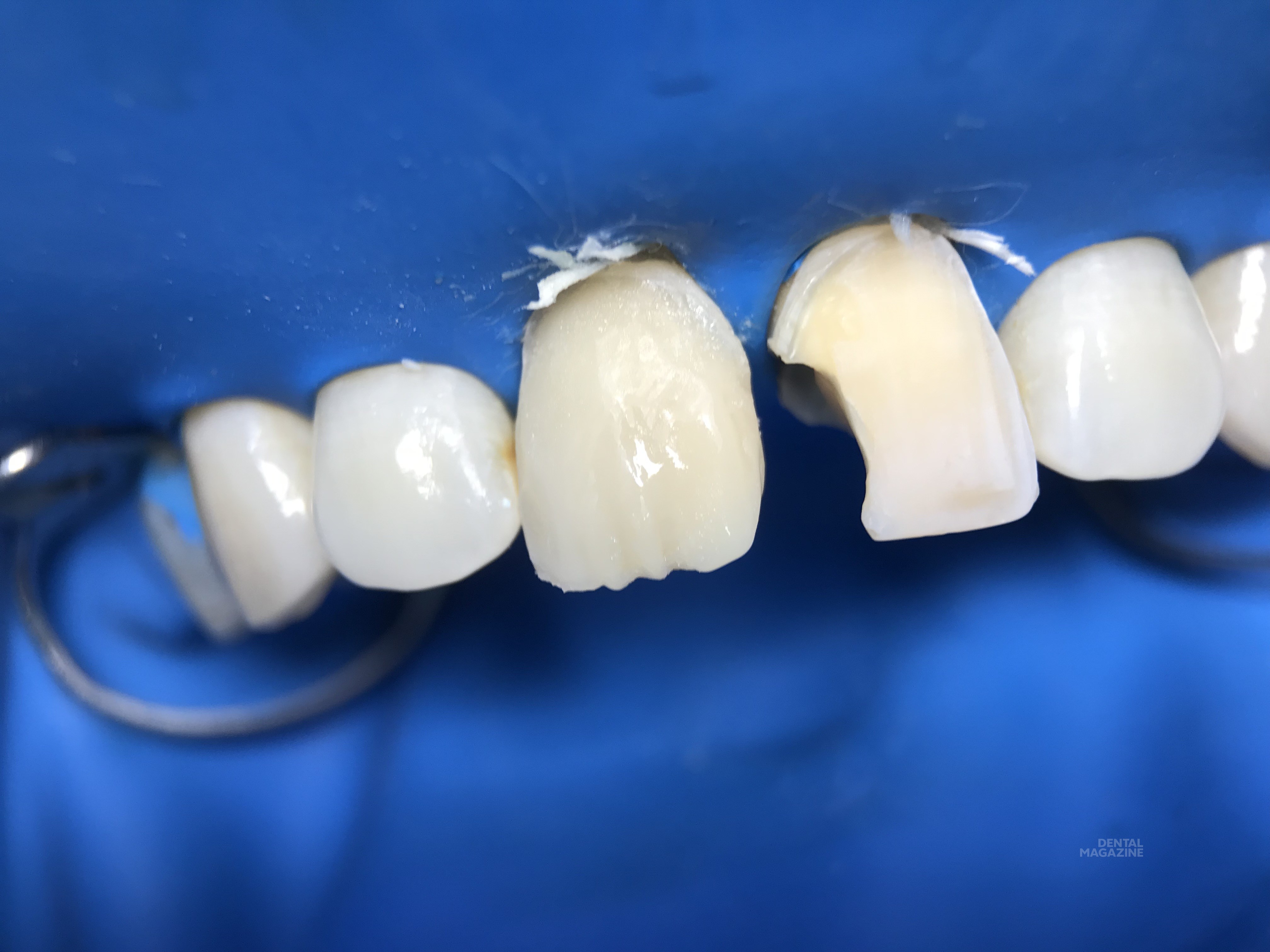 Зубная реставрация. Композиты для передних зубов. Композитные пломбы для зубов.