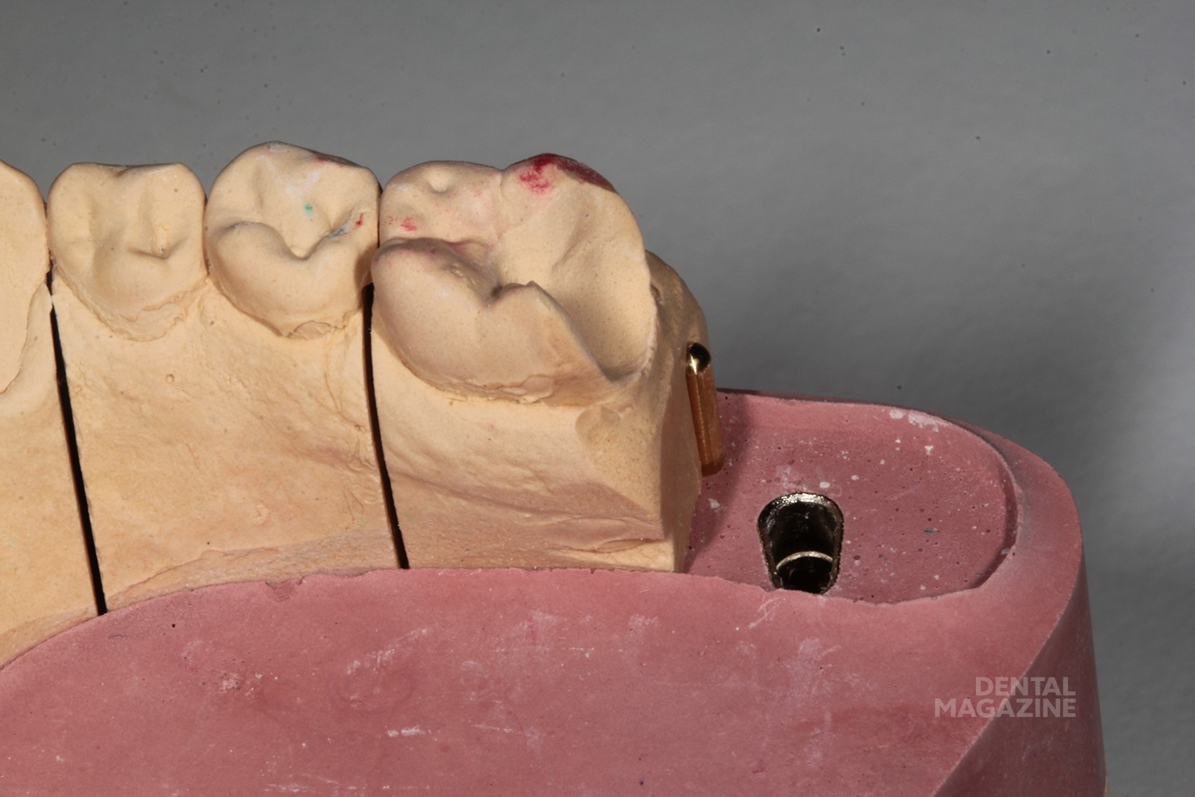 Керамические реставрации боковой группы зубов - DENTALMAGAZINE.RU